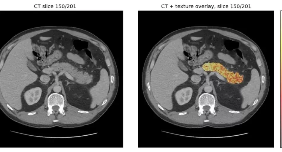 La IA logra anticipar el cáncer y abre una nueva esperanza