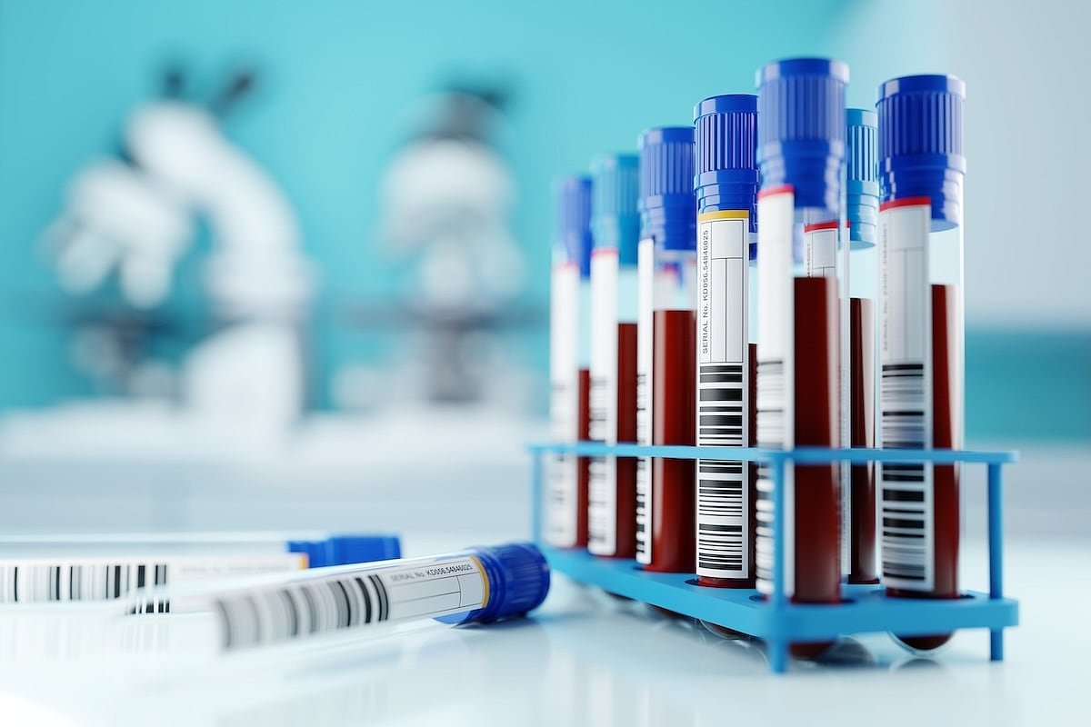 Las publicaciones en redes sociales son erróneas sobre los análisis de sangre para el Alzheimer