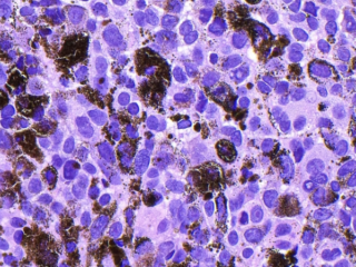 Una vacuna experimental de ARNm reduce en un 42 % el riesgo de reaparición del melanoma