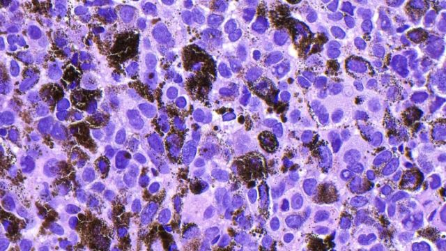 Una vacuna experimental de ARNm reduce en un 42 % el riesgo de reaparición del melanoma