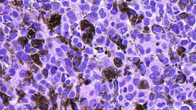 Una vacuna experimental de ARNm reduce en un 42 % el riesgo de reaparición del melanoma